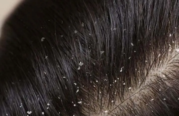 Rambut Ketombe