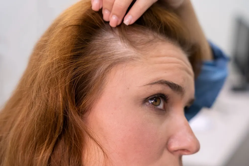Penipisan Rambut Usia Dini: Penyebab, Tanda-Tanda, dan Solusinya
