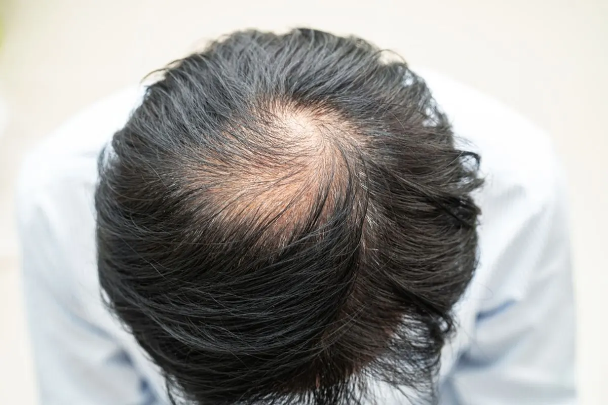 Kebotakan rambut pria