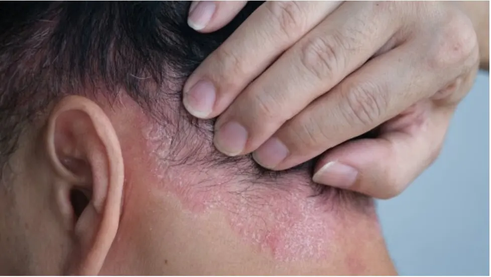 Atasi Rambut Ketombe Kering dan Gatal Ekstrem dengan 5 Langkah Alami Ini