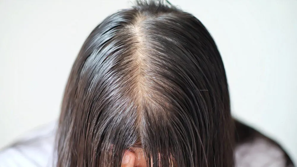 penipisan rambut