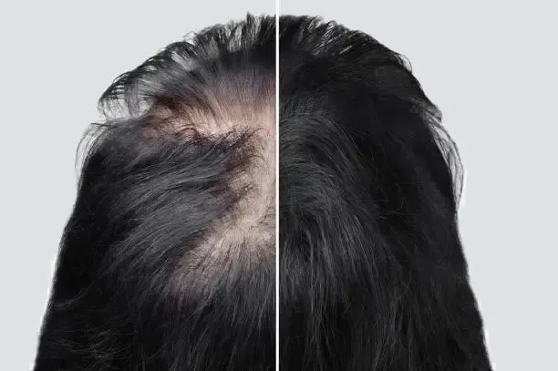 pertumbuhan rambut baru
