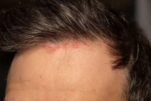 jerawat di hairline
