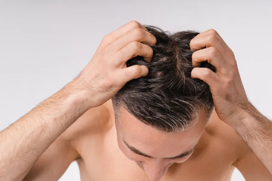 scalp kering